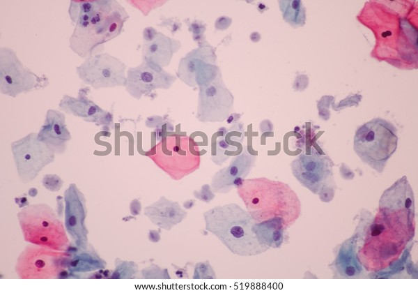 View Microscopic Trichomonas Spp Infection Pap Stock Photo (Edit Now ...