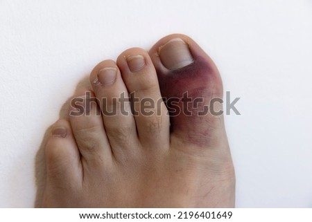 View of a stubbed or broken big toe on an adult male