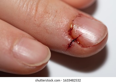 Vilnius / Lithuania - January 31, 2020: She Cut Through Herself Finger With The Knife While Made A Dish. A Stab Wound In Middle Finger And In The Nail.