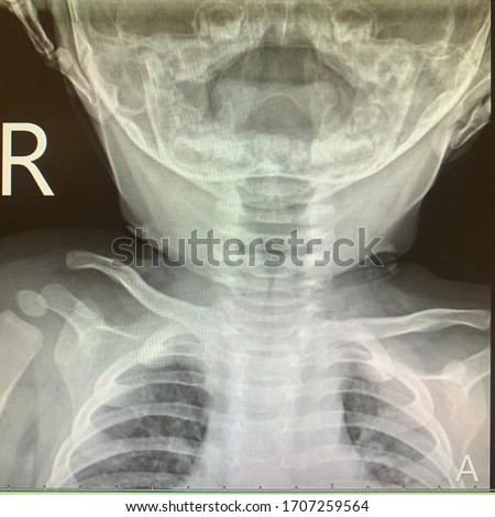 Viral croup in child steeple sign xray