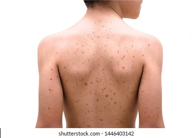 Viral Disease. Measles Eruption. Concept Of Outbreak Of Disease And Epidemic. Child On White Background With Skin Problem.