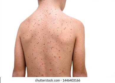 Viral Disease. Measles Eruption. Concept Of Outbreak Of Disease And Epidemic. Child On White Background With Skin Problem.