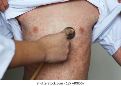 Viral Disease. Measles Rash. Concept Doctor And Patient. Allergy