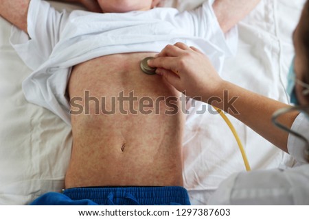 Viral disease. Measles rash. Concept doctor and patient. Doctor listens with a Stethoskope of a child sick’s measles