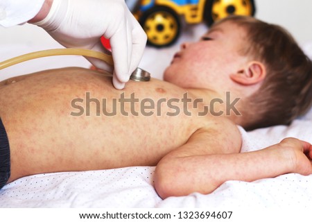 Viral disease. Measles rash. Concept doctor and patient. Child with viral infection measles and doctor with stethoscope