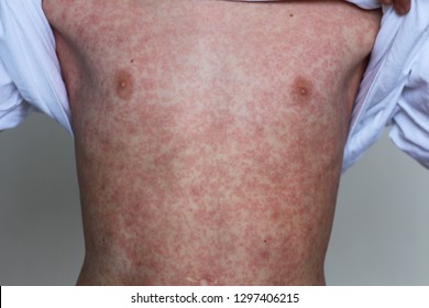 Viral disease. Measles rash on the body of the child. Allergy