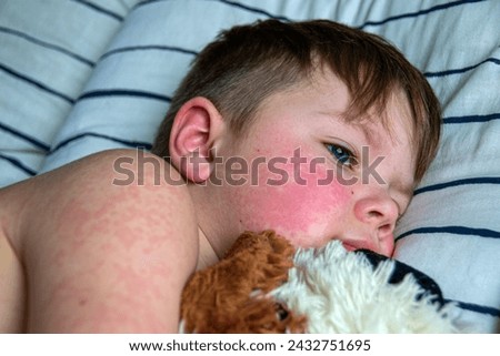 Viral disease. Measles rash on the body of the child. Allergy. A handsome boy with measles is sleeping in bed with his soft toy High quality photo