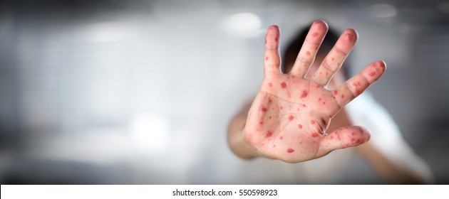 Viral Diseases - Hand Infected - Hand foot and mouth disease HFMD
