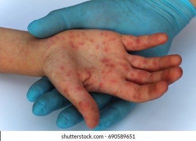Viral Diseases. Hand infected. Hand foot and mouth disease HFMD. Allergic. Doctor and patient. Red rashes on the palm of the hand.