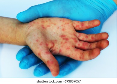 Viral Diseases. Hand infected. Hand foot and mouth disease HFMD. Allergic. Doctor and patient. Red rashes on the palm of the hand. Enterovirus. Coxsackie virus.