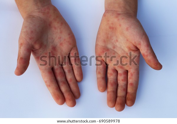 Viral Diseases Hand Infected Hand Foot Stock Photo (Edit Now) 690589978