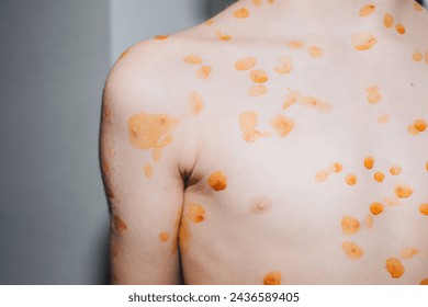 Viral diseases with a rash on the body. Chickenpox on the child's body. Treatment of chickenpox. Front view - Powered by Shutterstock