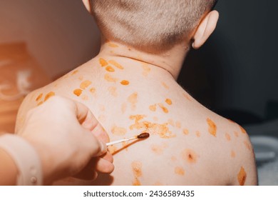 Viral diseases with a rash on the body. Chickenpox on the child's body. Treatment of chickenpox. Front view - Powered by Shutterstock