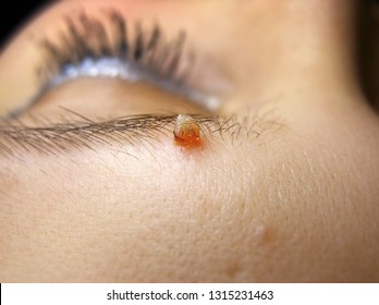 Viral Papilloma Of The Eyebrow Skin. Warts Removing Concept.