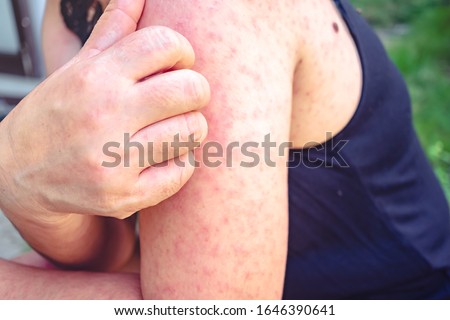 Viral skin disease Measles rash women with dermatitis of Itching of the blister on her arm dermatitis Urticaria on Body Health problem  symptoms Kawasaki disease-like condition linked to Coronavirus 