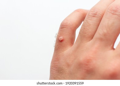 Viral wart on hand. Finger wart isolated on white background. Skin diseases