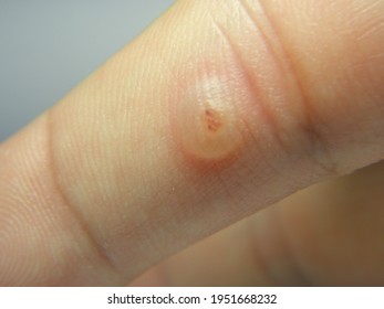 Viral Warts Cryotherapy, Blisters On The First Day After Treatment,Wart Warts Concept Of Warts On Blurred Neutral Background, Selective Focus       