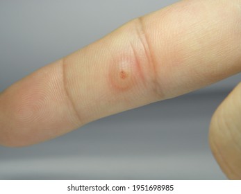 Viral Warts Cryotherapy, Blisters On The First Day After Treatment,Wart Warts Concept Of Warts On Blurred Neutral Background, Selective Focus       