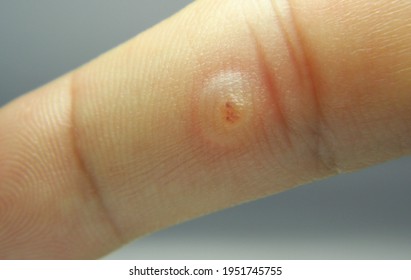 Viral Warts Cryotherapy, Blisters On The First Day After Treatment,Wart Warts Concept Of Warts On Blurred Neutral Background, Selective Focus       