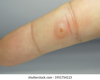 Viral Warts Cryotherapy, Blisters On The First Day After Treatment,Wart Warts Concept Of Warts On Blurred Neutral Background, Selective Focus       