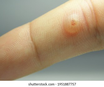 Viral Warts Cryotherapy, Blisters On The First Day After Treatment,Wart Warts Concept Of Warts On Blurred Neutral Background, Selective Focus           