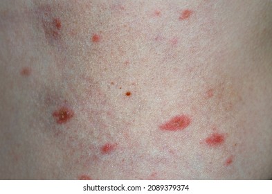 Virus Abdomen Infection Pityriasis Rosea Gibert Stock Photo (Edit Now ...