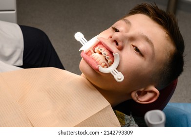 Visit To The Orthodontist, Installation Of Braces On The Upper Teeth, White Retractor On The Lips Of The Child, Alignment Of The Teeth.