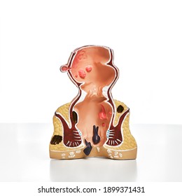 Visual anatomical model of the human rectum, with pathologies, close-up, on a white background