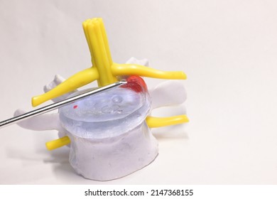 Visual Color Mockup Of Biopsy Needle Penetrating Lumbar Disc Herniation