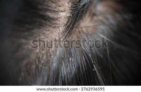 Visualizing scalp problems, white crusts and dry dandruff flakes in the hair
