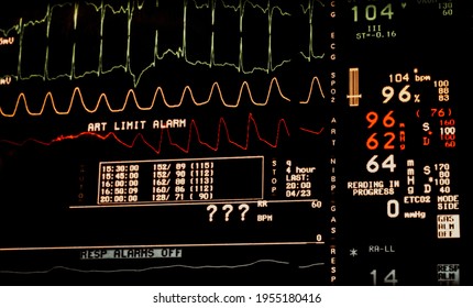 Vital Sign Monitor In ICU EKG, Oxymetry And Blood Pressure 