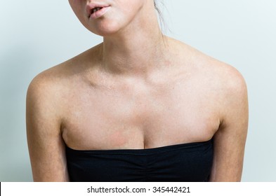 Vitiligo Affected Female Chest And Face