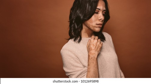 Vitiligo Affected Young Woman In Studio. Female With Bad Tan Problem Standing On Brown Background.