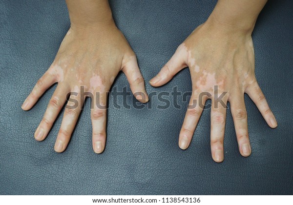 Vitiligo Hands Multiple Well Circumscribed Hypopigmented Stock Photo ...