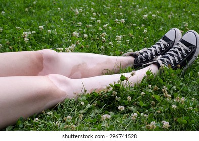 Vitiligo Legs On The Green Grass And White Clovers