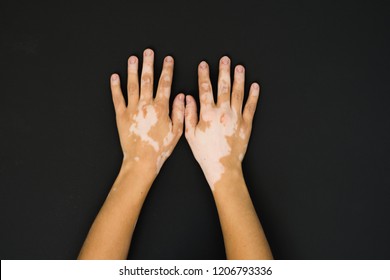 Vitiligo On The Hands