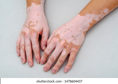 Vitiligo On Skin Of Hands.