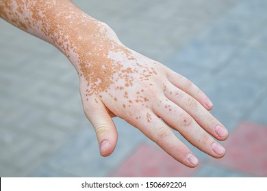 Vitiligo Skin Disease On Hand Closeup