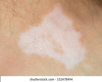 Vitiligo spot on the ankle