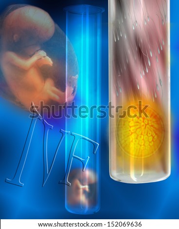 In vitro fertilization (IVF) is a process by which egg cells are fertilized by sperm outside the womb, in vitro. IVF is a major treatment in infertility when other methods have failed.