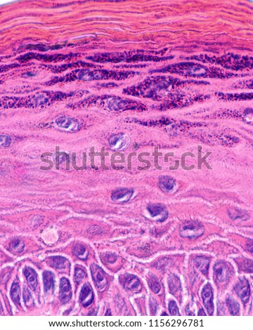 Vocal cord polyp. The covering epithelium show the layers of a thin skin, i.e., stratum basale, spinosum granulosum and corneum.