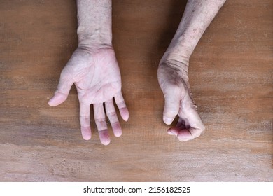 Volkmann Contracture In Left Upper Limb Of Southeast Asian Elder Man. It Is A Permanent Shortening Of Forearm Muscles That Gives Rise To A Clawlike Posture Of The Hand, Fingers, And Wrist.