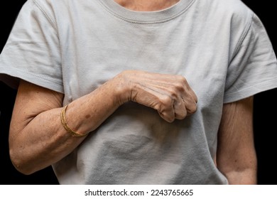 Volkmann contracture in left upper limb of Southeast Asianold  woman. It is a permanent shortening of forearm muscles that gives rise to a clawlike posture of the hand, fingers, and wrist.