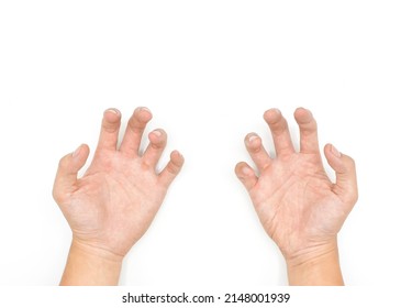 Volkmann Contracture In Upper Limb Of Asian Young Man. It Is A Permanent Shortening Of Forearm Muscles That Gives Rise To A Clawlike Posture Of The Hand, Fingers, And Wrist.