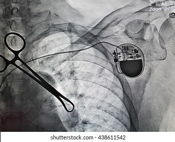 VVIR Pace Maker In X-ray Image In Cardiac Catheterization Laboratory