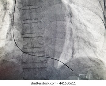 VVIR Pacemaker Cable In X-ray Image In Cardiac Catheterization Laboratory