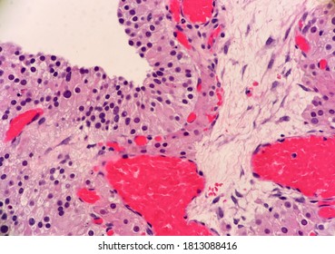 Wall Of A Benign Follicle Cyst Of The Ovary. Ovarian Cyst And Blood Vessels. Microscopic View.