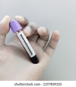 Warfarin Sensitivity Genotyping Testing In PCR Laboratory, To Diagnose The Tolerance Of The Drug Warfarin.