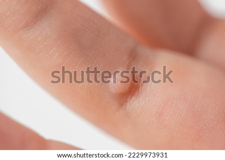 Wart on the finger. Close-up of a wart on a child's finger. The common wart Verruca vulgaris is caused by a type of human papillomavirus, HPV.