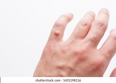 wart on a finger on a white background - Shutterstock ID 1431198116